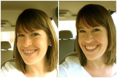 Before/after the day I got my braces off!